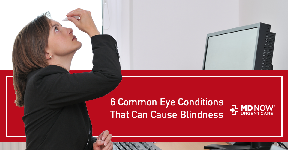 6 Eye Conditions Can Cause Blindness MD Now Urgent Care